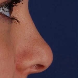 Close-up of a patient's nose before rhinoplasty surgery.