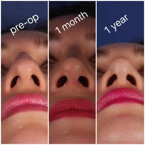 Comparison of nasal shape before surgery, 1 month, and 1 year post-op.